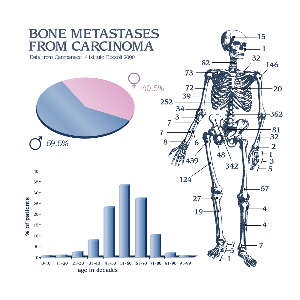 What is the success rate with spinal cancer treatment?