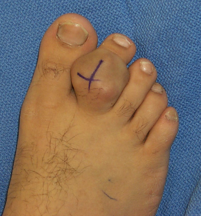 Giant Cell Tumor Of Tendon Sheath Foot And Ankle Bonetumor Org