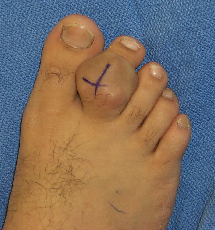 Growth on hotsell foot tendon