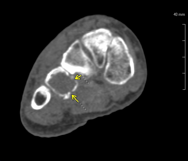 Aneurysmal Bone Cyst Foot And Ankle