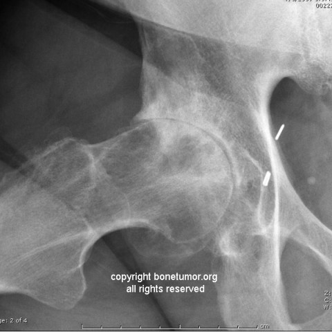 subchondral cyst icd 10